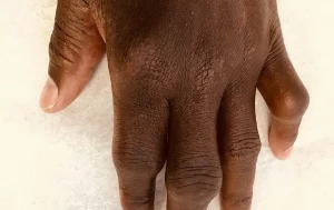 Hands that have gout