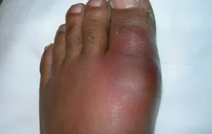 gout of the big toe