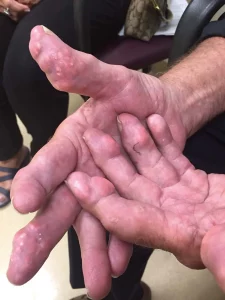tophi hands from gout