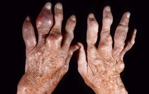 very disfigured hands gout